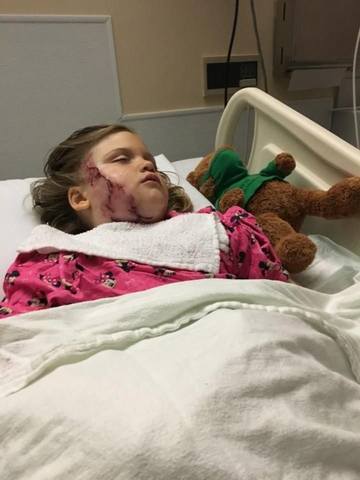 Хаски разорвала 5-летней девочке лицо и сломала челюсть