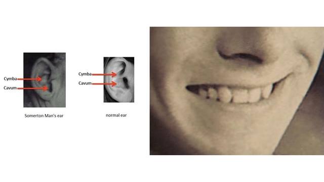Вчені дійшли висновку, що Робін не лише мав форму вух, як у сомертонського чоловіка, але також не мав бічних різців. Джерело: Derek Abbott / eleceng.adelaide.edu.au