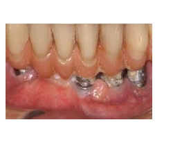 https://denterum.ru/prizhivaemost-implantov зубные имплантаты