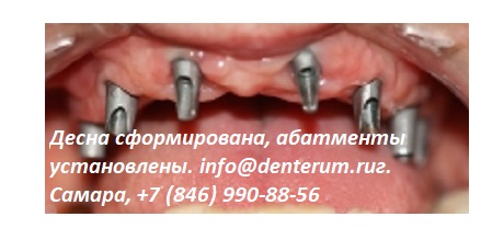 https://denterum.ru/implantacziya-vse-na-chetyirex зубные имплантаты Самара