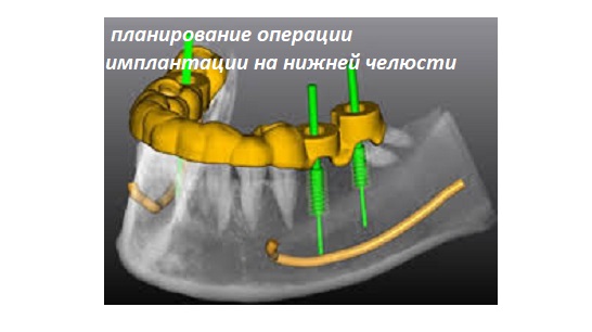  https://denterum.ru/uxod-za-implantantami зубные имплантаты планирование операции установки на шаблоне