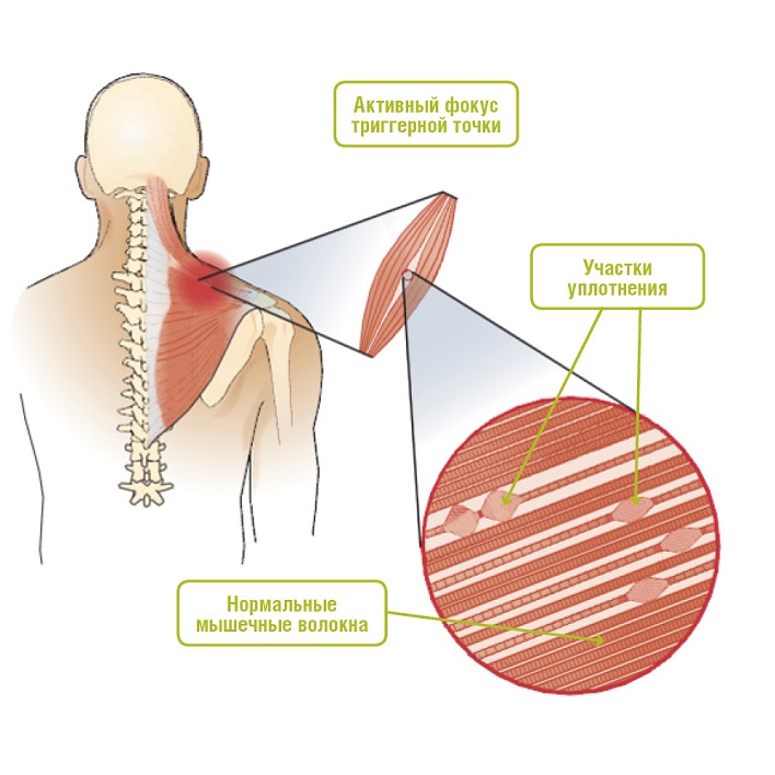 Триггерные точки шея голова
