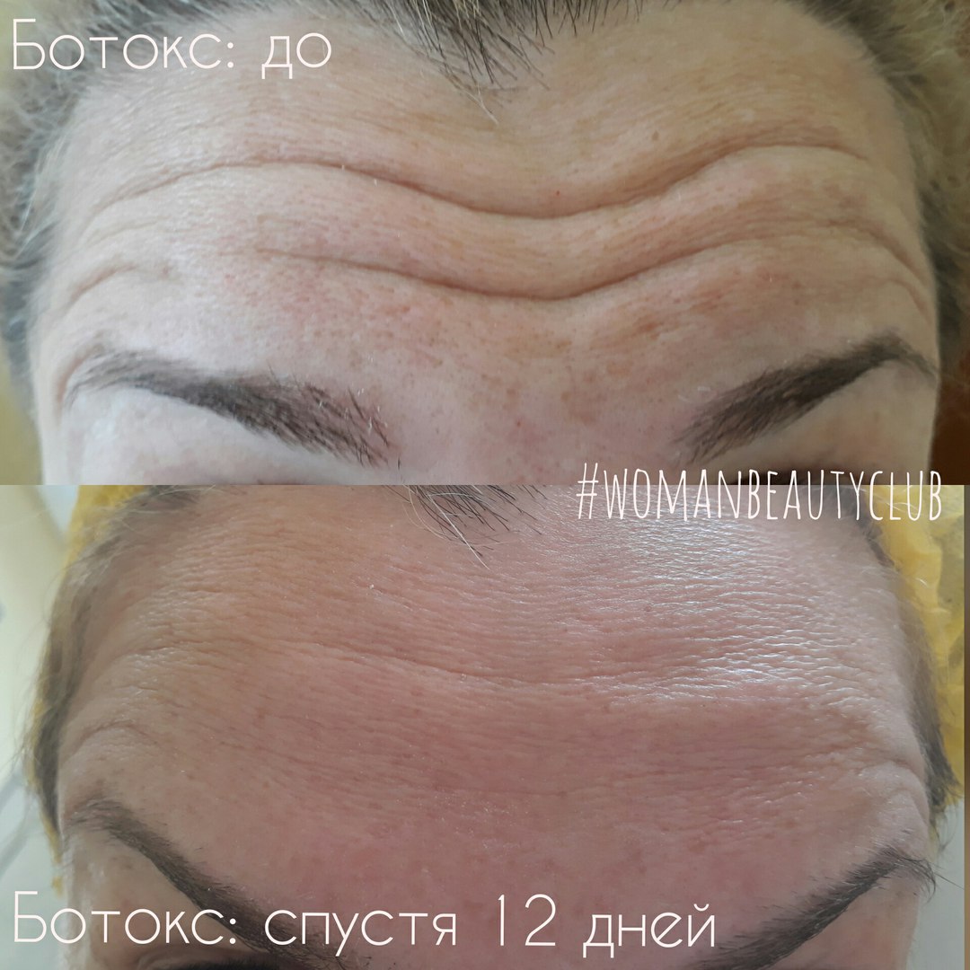 Как выглядит лоб после ботокса ботокс лоб / VFL.Ru - надёжный и быстрый фотохостинг с 2009 года